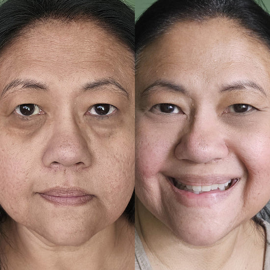 YouthBeam – Red Light Therapy for Tired Eyes!